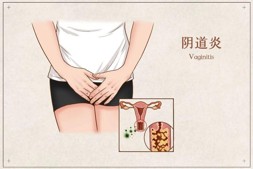 珠海醫院｜女性夏天私處癢，別再亂用藥了！